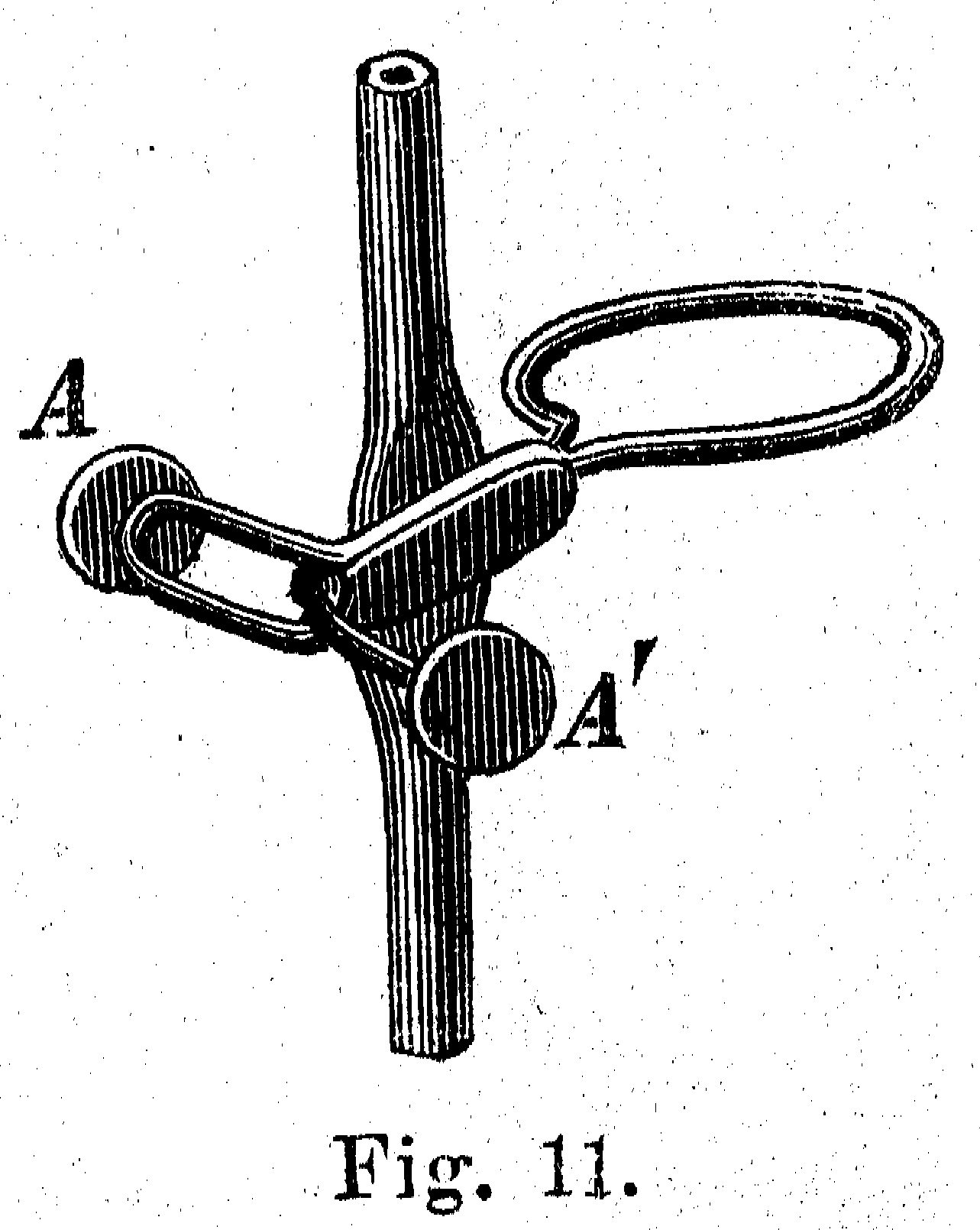Mohr clip (Alessandri 1895.11)